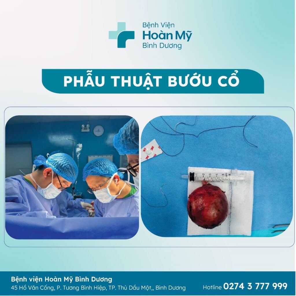 Phẫu thuật bướu cổ cho bệnh nhân nữ 21 tuổi tại Bệnh viện Hoàn Mỹ Bình Dương