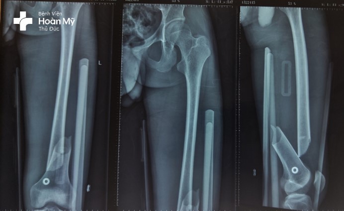 X-quang đùi trái trước mổ gãy 1/3 dưới thân xương đùi trái di lệch nhiều