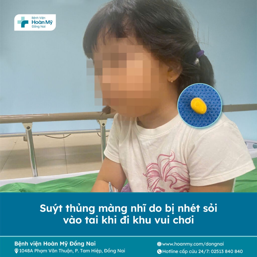 Suýt thủng màng nhĩ vì bị nhét sỏi vào tai