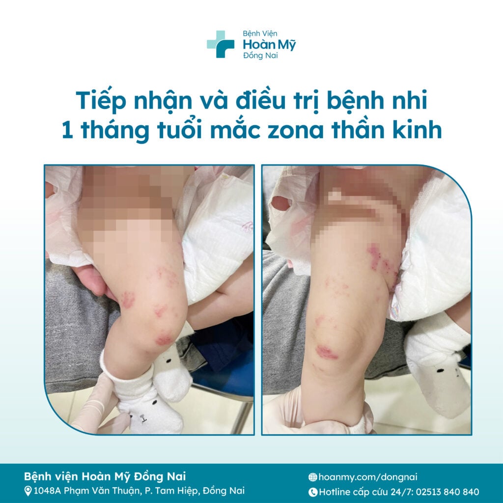 Tiếp nhận và điều trị bệnh nhi 1 tháng tuổi mắc Zona thần kinh
