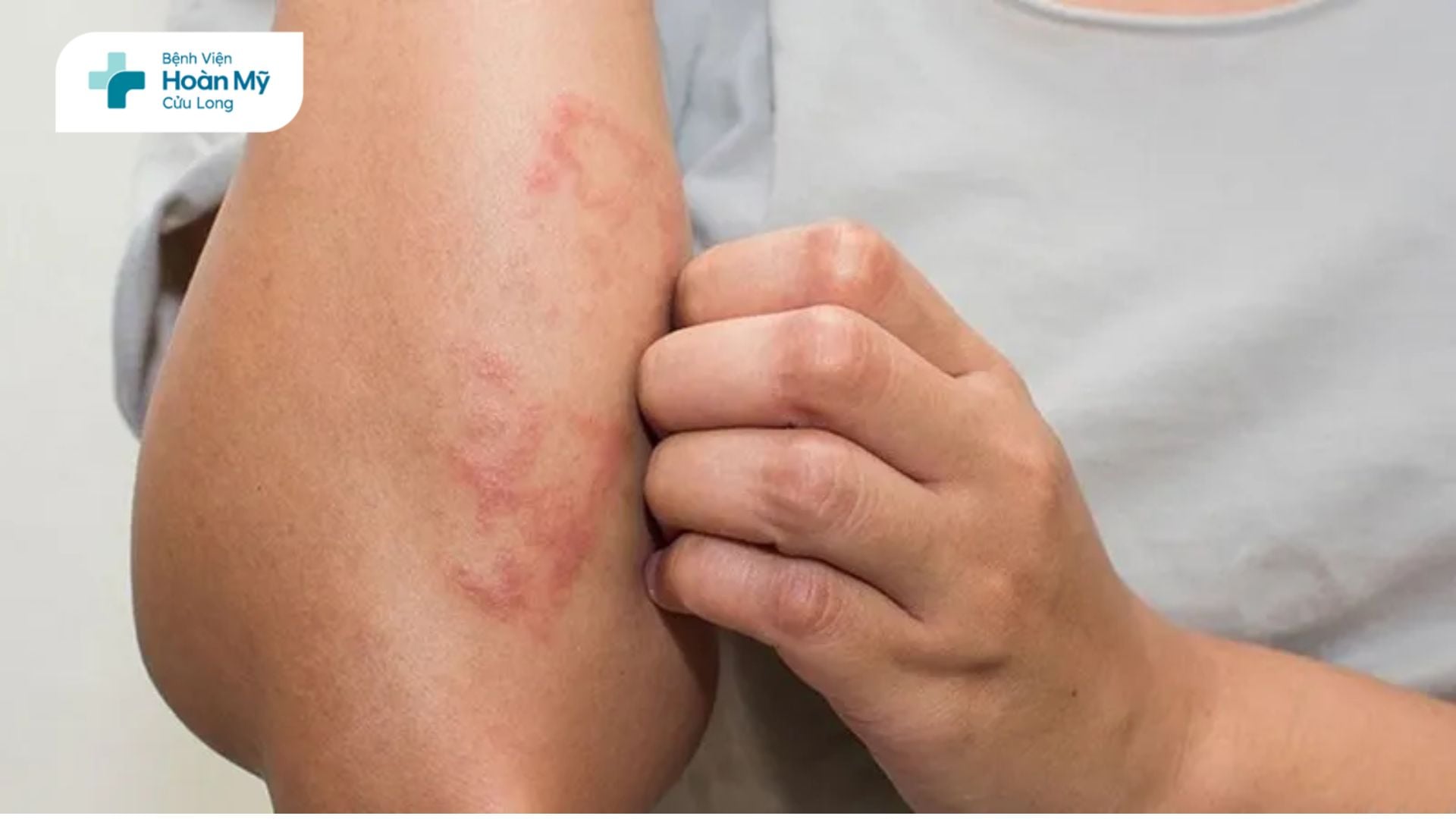 Ngứa da: Dấu hiệu cảnh báo sức khỏe không nên chủ quan